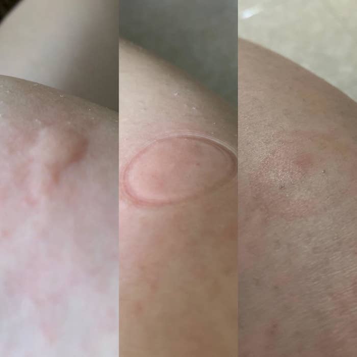 A collage of a reviewer&#x27;s bug bite, the round suction mark after using the bug bite tool, and then the almost completely faded bug bite