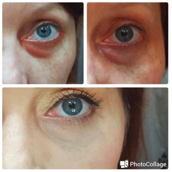 A series of customer review photos showing their undereye area before and after using the correctors