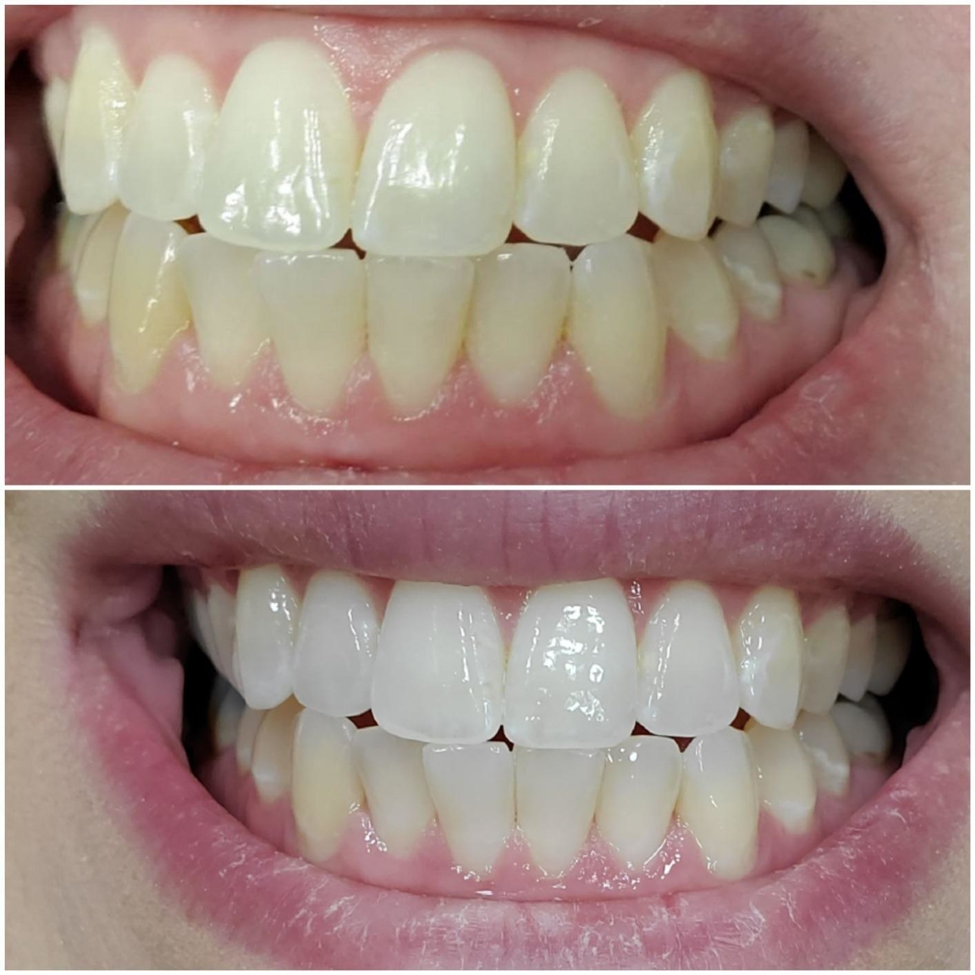 A before/after of a reviewer&#x27;s teeth, yellower before and whiter after