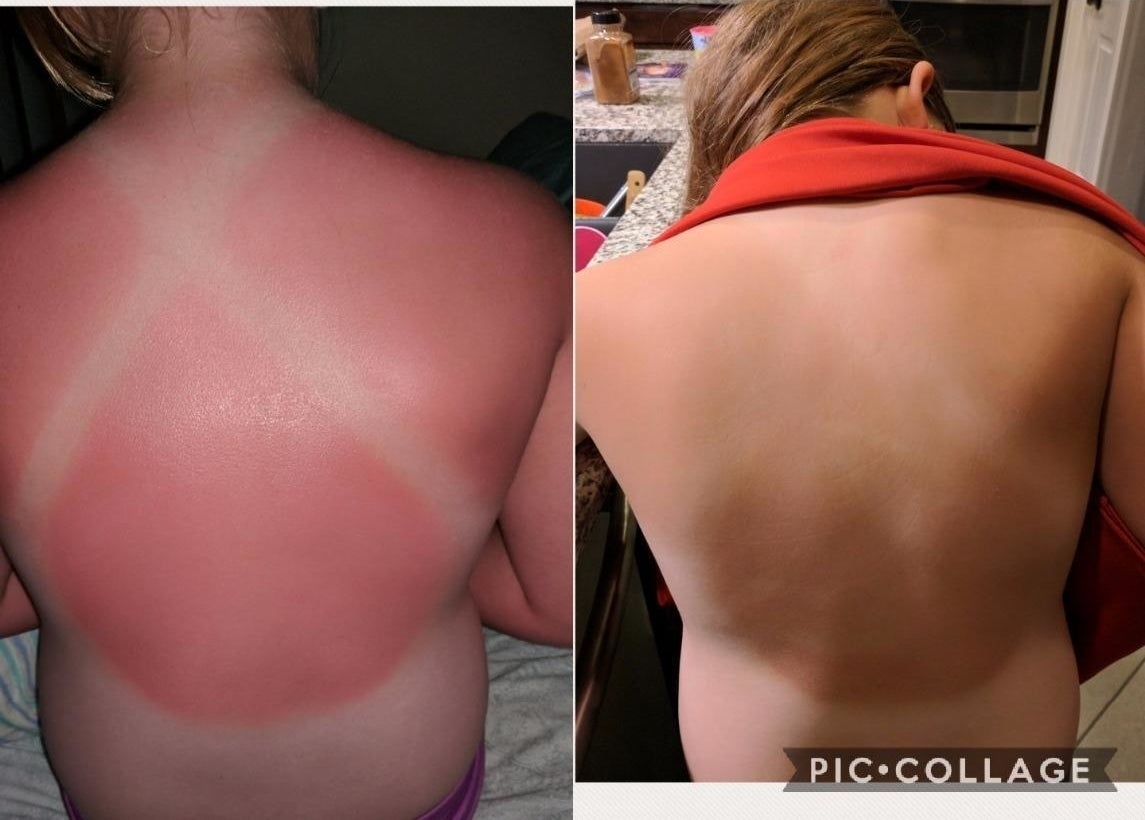 A reviewer&#x27;s back on the left very sunburnt, and on the right almost completely faded