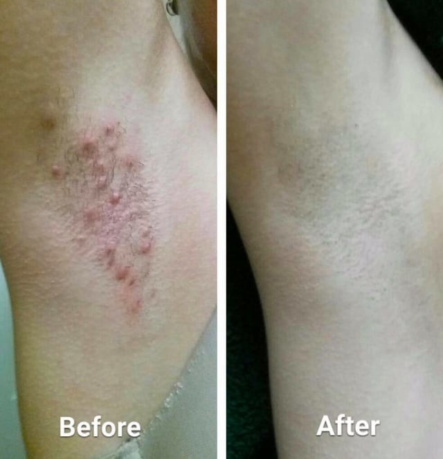 Before/after pic of reviewer&#x27;s armpits with significant razor burn and bumps. The after photo shows smooth skin with no bumps or irritation.
