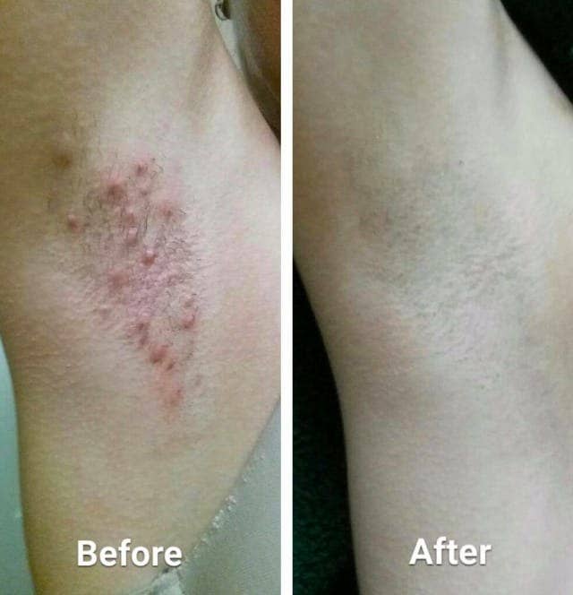 Before/after pic of reviewer's armpits with significant razor burn and bumps. The after photo shows smooth skin with no bumps or irritation.