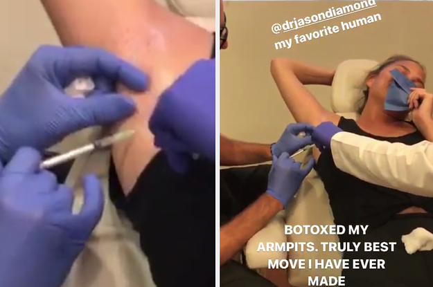 Chrissy Teigen Revealed On Instagram She Got Botox On Her Armpits To Stop Sweating