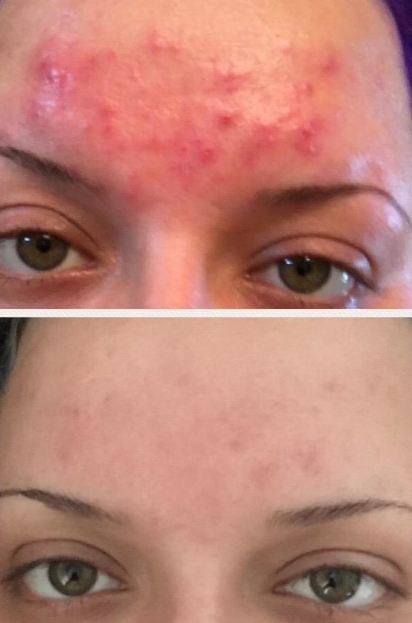 before and after with a forehead covered in bright red breakouts and the same forehead nearly free of breakouts