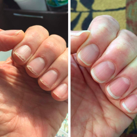 a before and after of the fingernails 