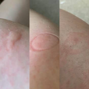 side-by-side of a reviewer's progression of a bug bite before and after using the product showing the swelling has gone down