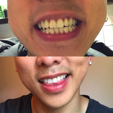a before and after photo of dingy teeth and white teeth