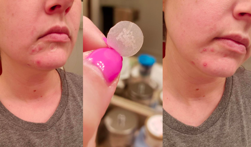 These 9 Acne Patches Are Quite Possibly The Most Satisfying Thing I Ve Ever Seen