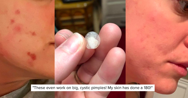 These 9 Acne Patches Are Quite Possibly The Most Satisfying Thing I Ve Ever Seen