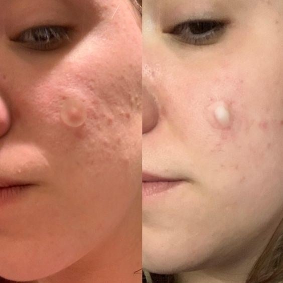 Reviewer&#x27;s before-and-after of wearing the pimple patch over their pimple, and the pimple patch filled with pus 