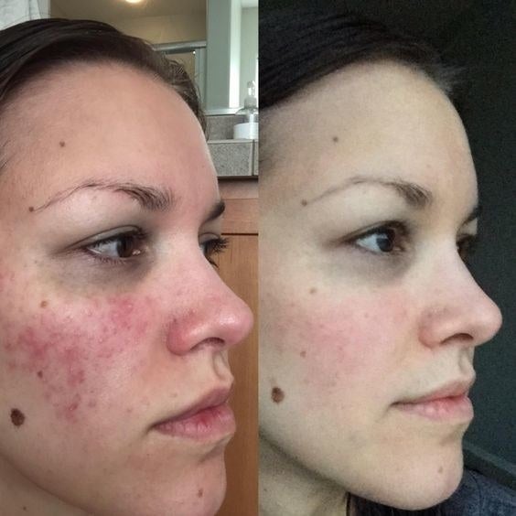Reviewer&#x27;s before-and-after picture with red complexion and then almost totally clear complexion 