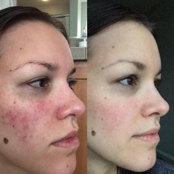 Reviewer's before-and-after picture with red complexion and then almost totally clear complexion