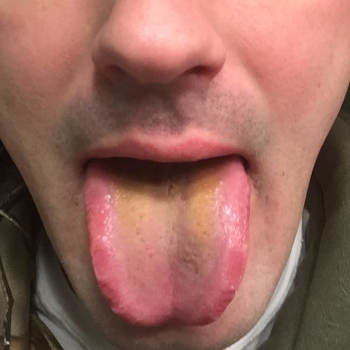 A reviewer sticking out their tongue "before"; there's a coating of yellow on it