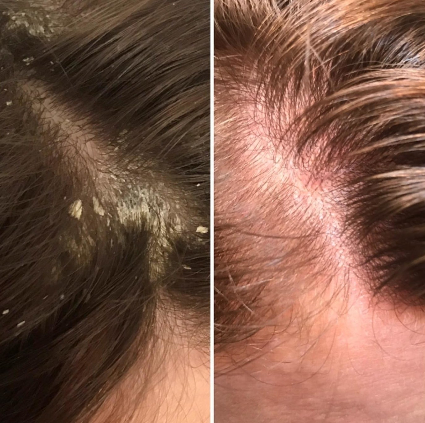 Before: A reviewer&#x27;s scalp with lots of flaky dandruff; After: the same scalp, no dandruff in sight