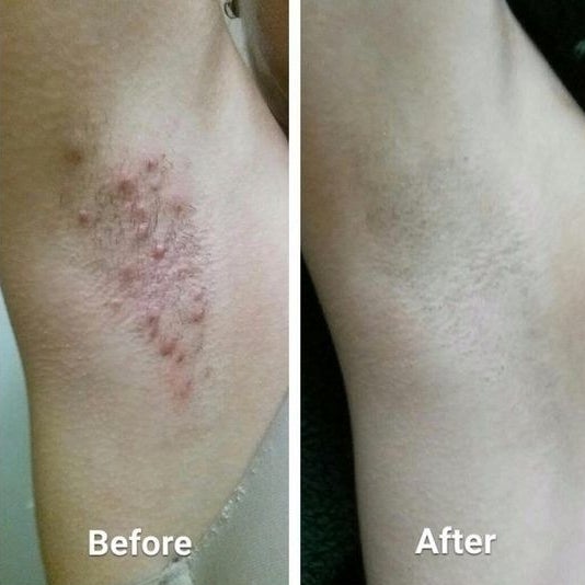 Reviewer&#x27;s before-and-after of armpit with razor burn and then smooth armpit 