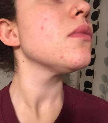 After photo of the same reviewer showing the mask dramatically reduced the redness and amount of breakouts