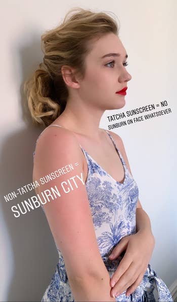 BuzzFeed editor showing a sunburned arm that didn't have the tatcha sunscreen on it and a non-sunburned face that did have the sunscreen on