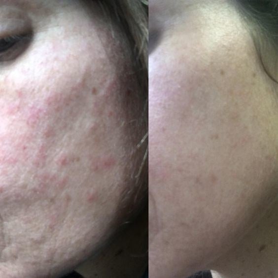 Reviewer&#x27;s before-and-after of cheek with acne, and then totally clear