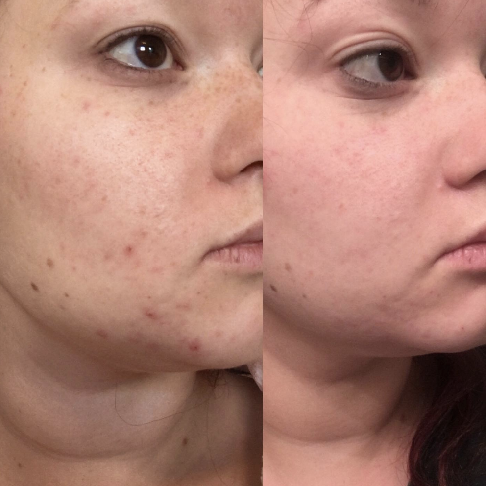 Left side shows reviewer with pimples, redness, and acne scars while the right side shows the same person with zero redness, only one or two scars, and no pimples