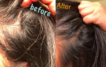 A before and after customer review photo of their head with and without dandruff