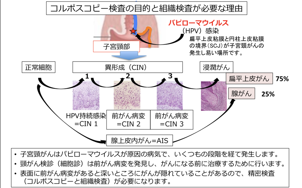 子宮頸がん検診で異常が出たらどんな治療をするの 予防に勝る治療なし