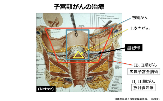 子宮頸がん検診で異常が出たらどんな治療をするの 予防に勝る治療なし