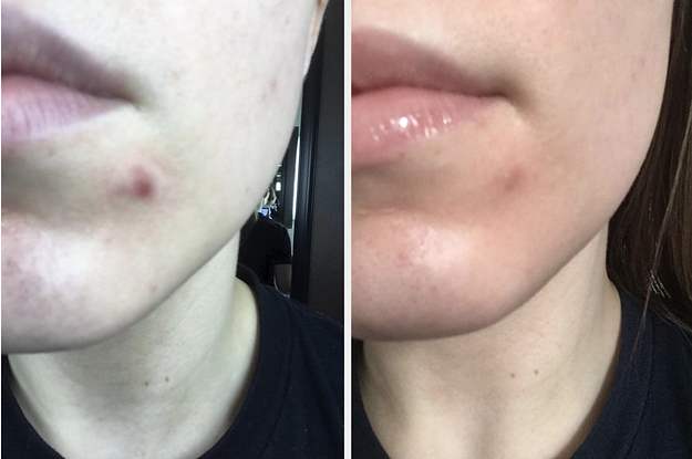 20 Acne Products Under $20 That Reviewers Actually Swear By