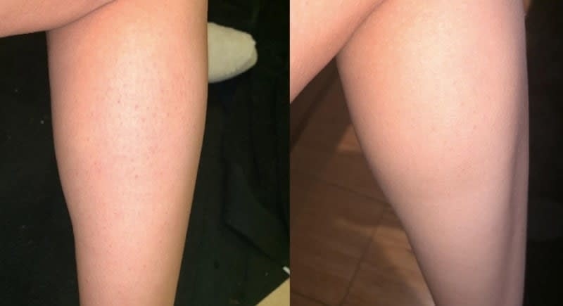On the left, a reviewer&#x27;s calf with some small razor bumps, and on the right, the same reviewer&#x27;s calf now clear of razor bumps