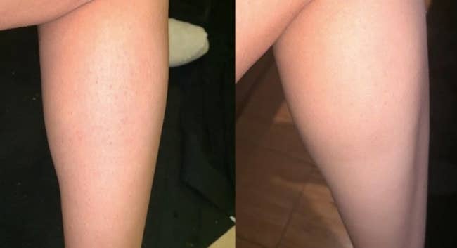 reviewer before and after for tend skin solution