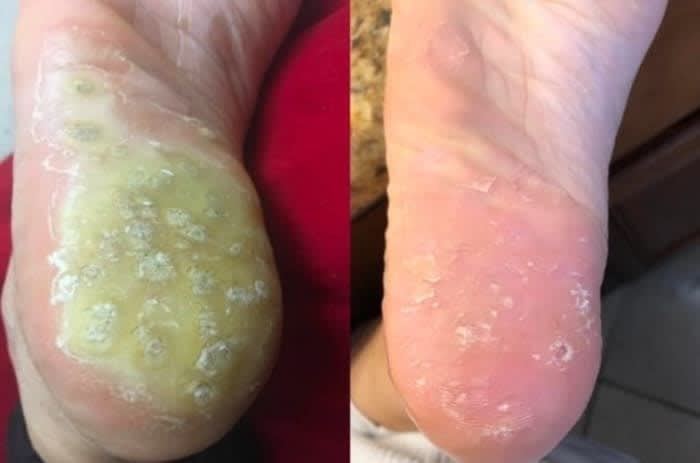 On the left, the bottom of a reviewer&#x27;s foot mostly covered in warts, and on the right, the same reviewer&#x27;s foot now mostly cleared of warts