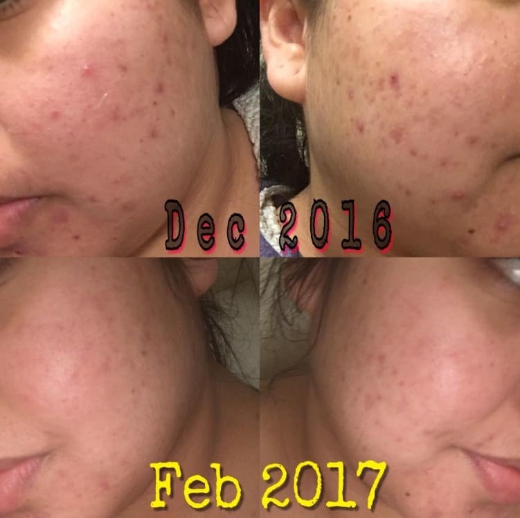 On the top, a reviewer&#x27;s face with acne in December 2016, and on the bottom, the same reviewer with most of their acne going down in February 2017