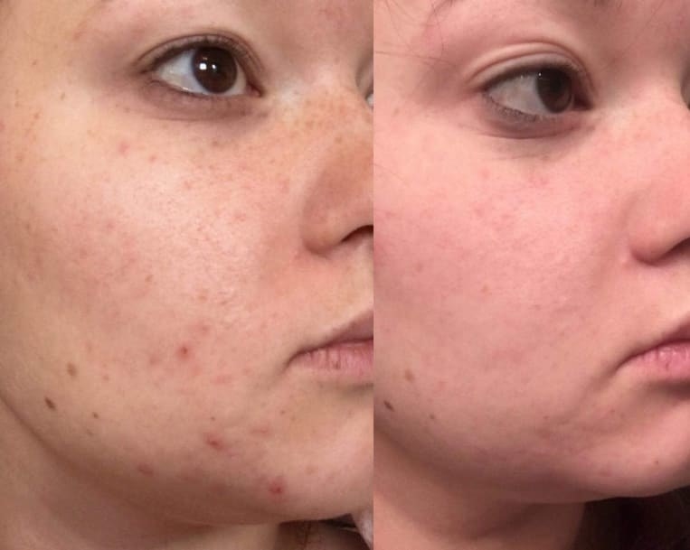 On the left, a reviewer with some acne on their face, and on the right, the same reviewer&#x27;s face with most of the acne cleared up