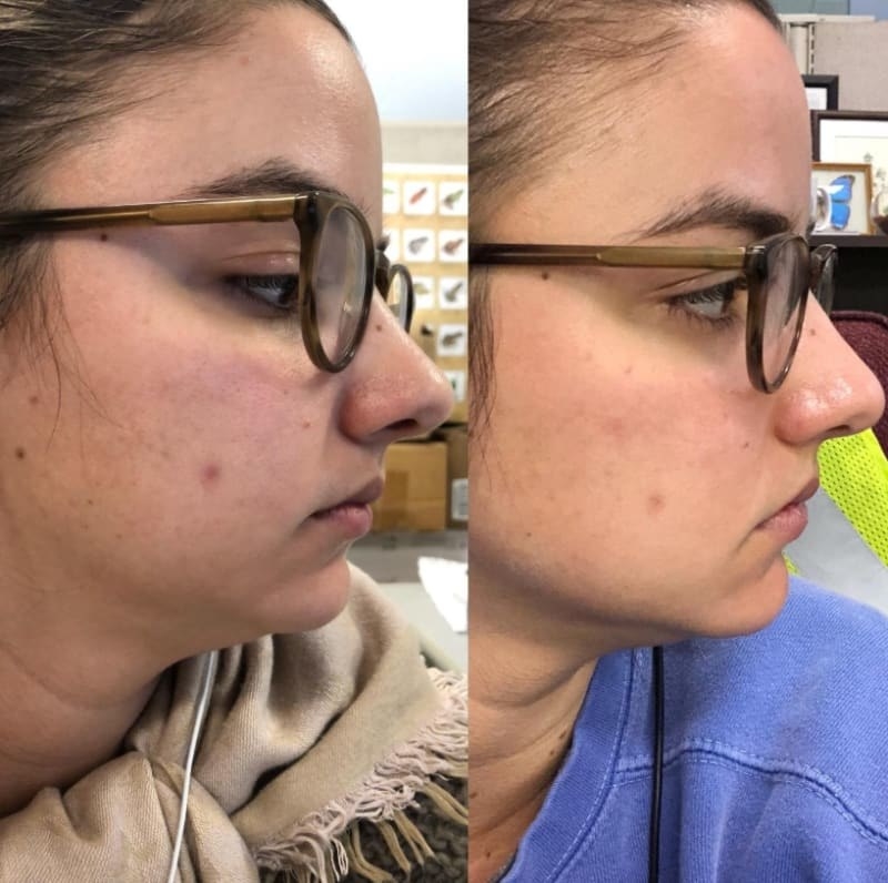 On the left, a reviewer showing thy have a zit on their cheek, and on the right, the same reviewer&#x27;s zit has mostly gone down, and their skin looks smoother and brighter