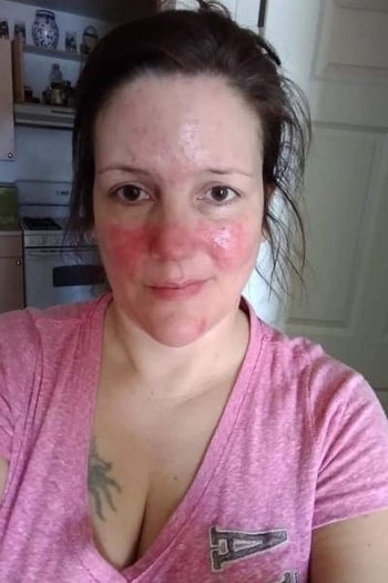A reviewer showing their face has redness 