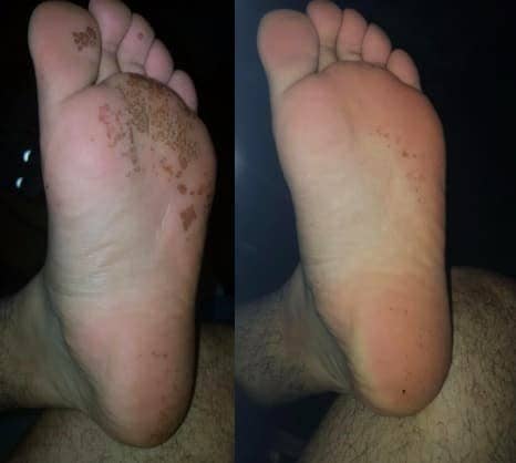 On the left, punched-out pits on the bottom of a reviewer's foot from pitted keratolysis, and on the right, the same reviewer's foot with most of the pits mostly gone after using the wash