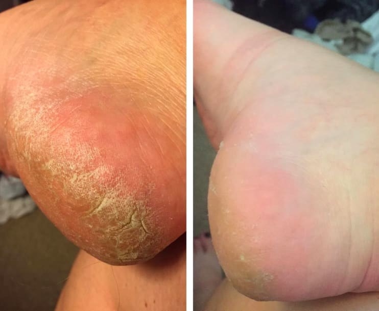 On the left, a reviewer&#x27;s heel looking dry and cracked, and on the right, the same reviewer&#x27;s heel looking much less dry and cracked and more smooth