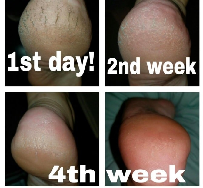 A reviewer showing the progression of their heel looking dry and cracked on the first day they started using the cream, to being much softer and smooth by the fourth week