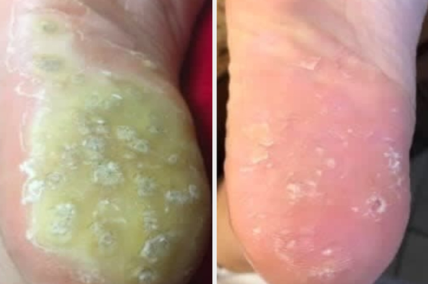 27 Skincare Products With Before-And-After Photos That Gave Me Goosebumps