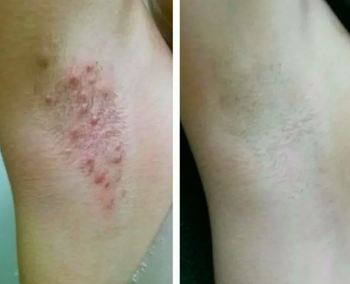 reviewer before pic of red bumpy arm pit, then after of clear armpit