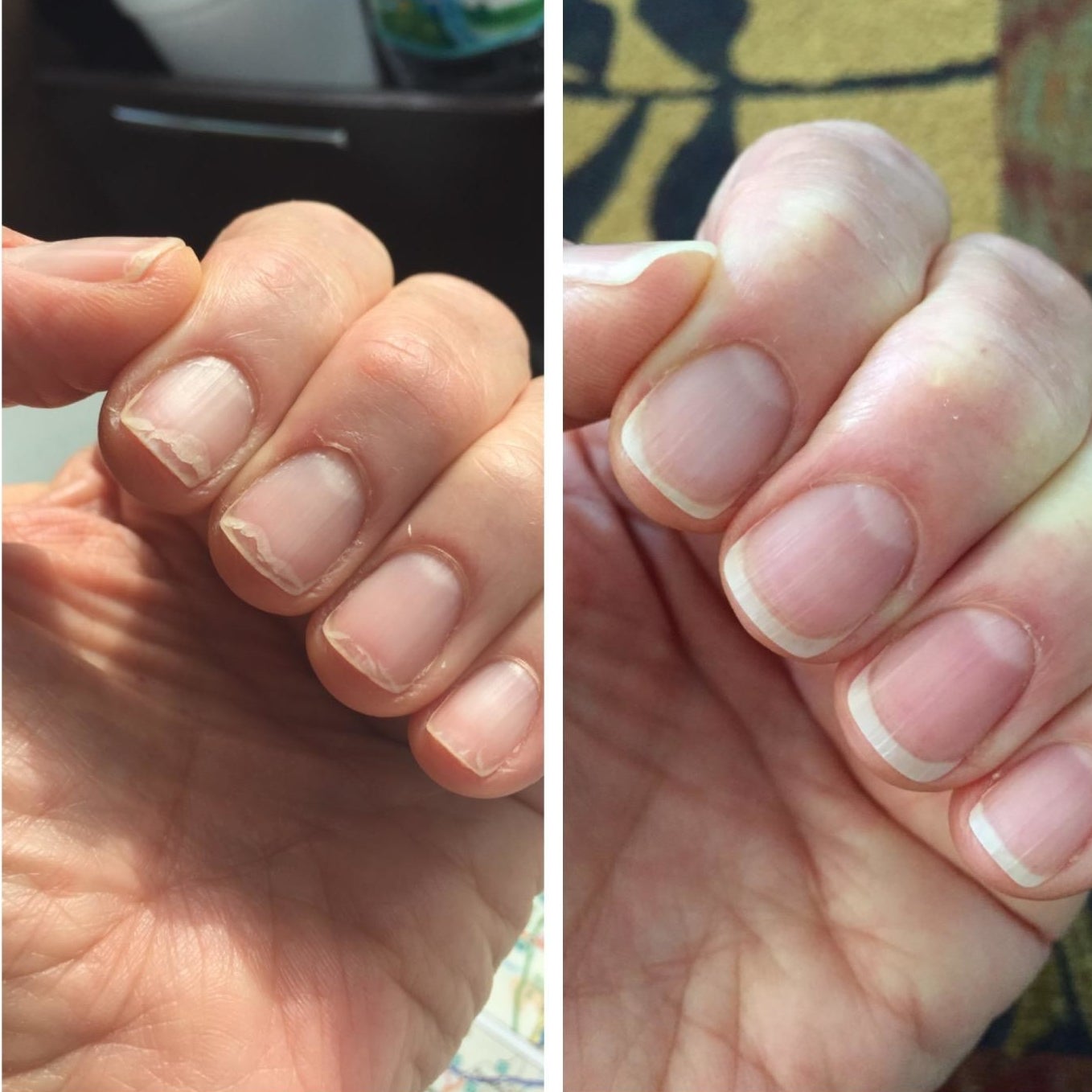 left: peeling nails right: no more peeling