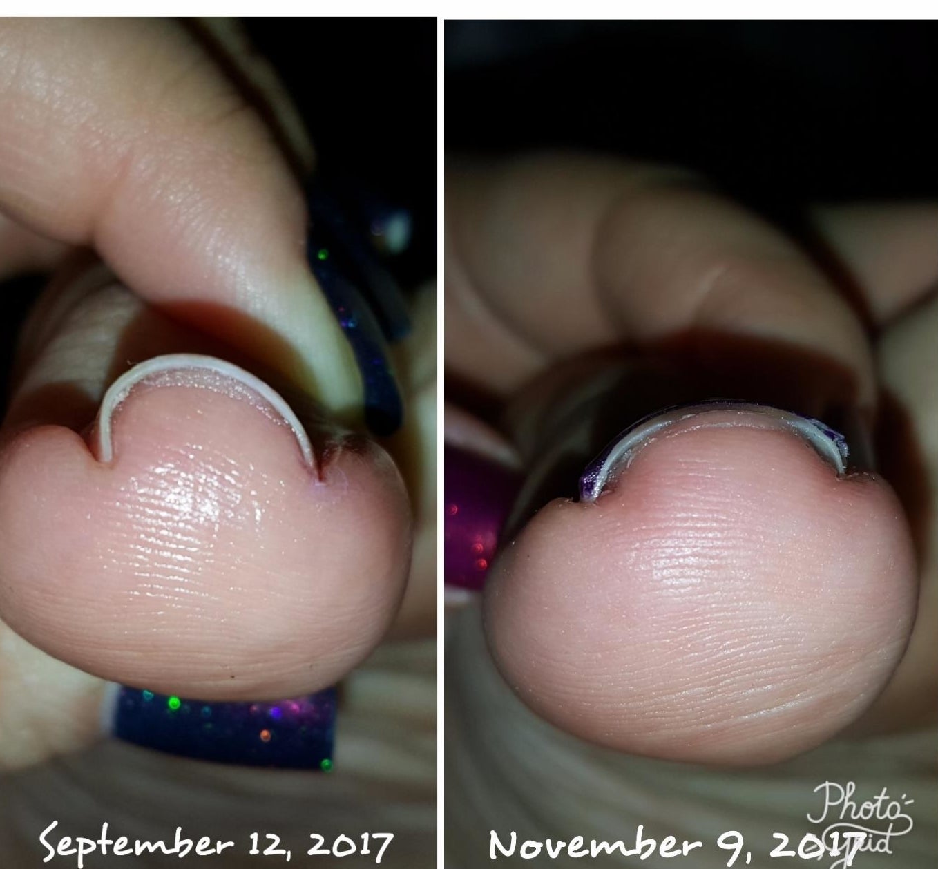 left: bent, u-shaped nail in september right: normal looking nail by november 