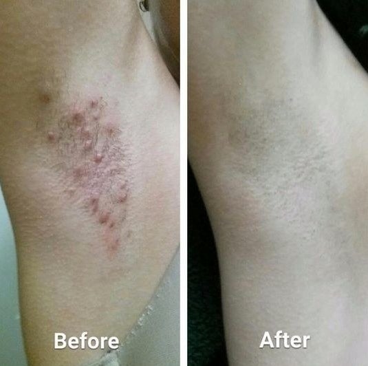 Reviewer&#x27;s before and after of their armpit with razor bumps, and then totally smooth 