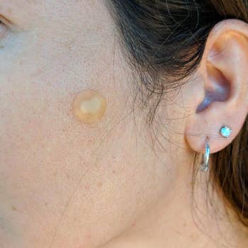 A reviewer with a small transparent circular patch on their cheek, which is filling with pore pus