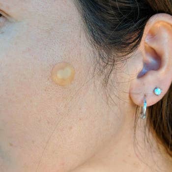 A reviewer with a small transparent circular patch on their cheek, which is filling with pore pus