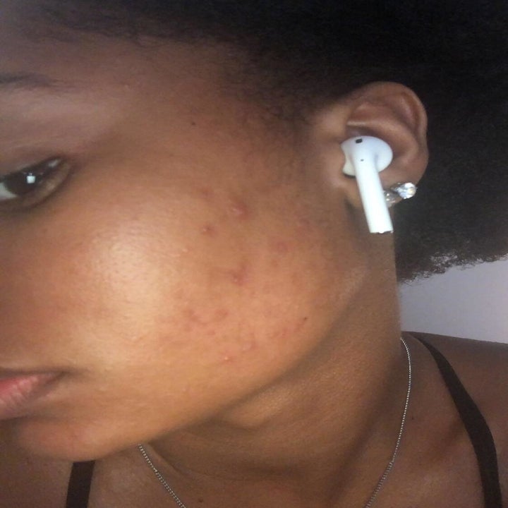 same reviewer's cheek with less acne spots and redness after using the clay mask