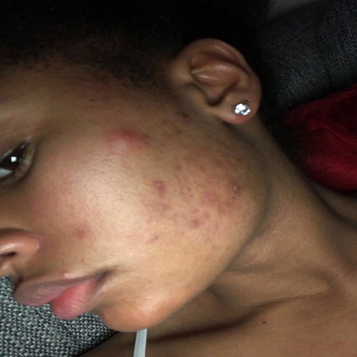 reviewer's cheek covered in acne spots