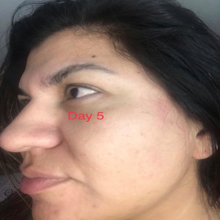 same reviewer's skin with less dark spots after using the serum for five days