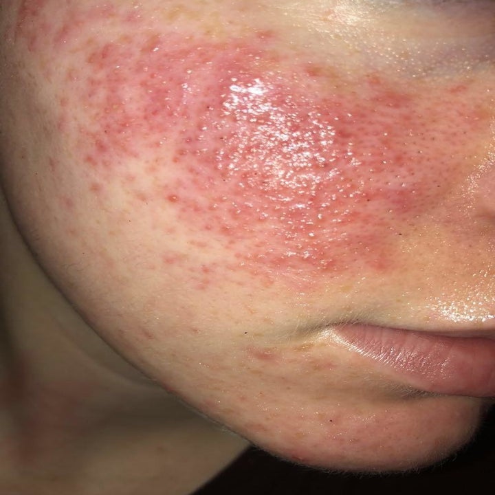 reviewer's cheek with redness and bumps