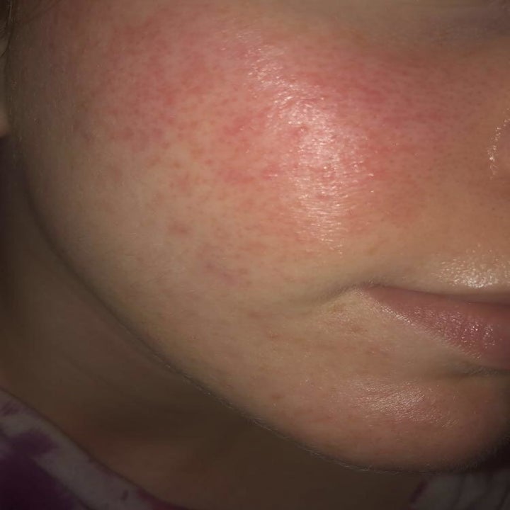 same reviewer's cheek with less redness and bumps after using the liquid exfoliant