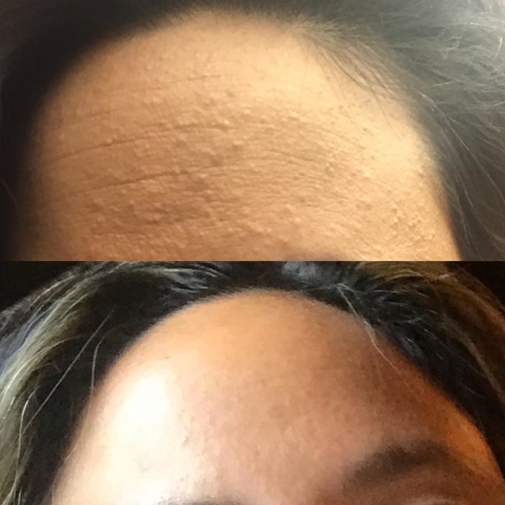 on top, reviewer's forehead with creases and pimples. on bottom, same reviewer's forehead with less pimples and smoother skin